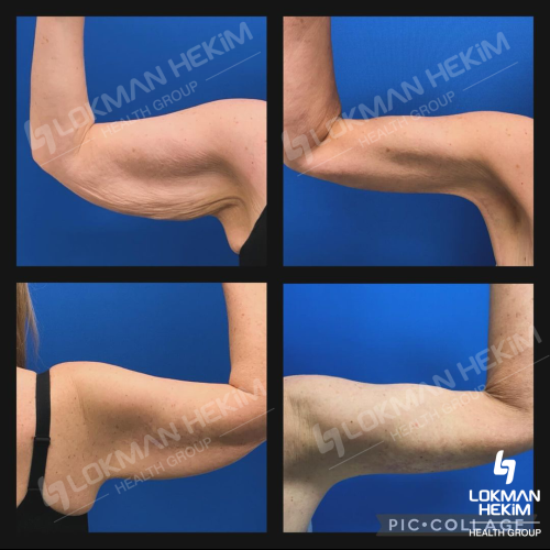 Брахиопластика Фотографии до и после